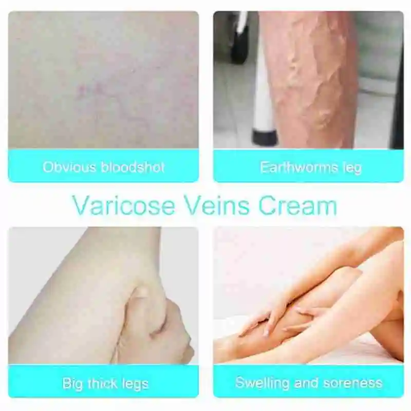 Крем от варикозного расширения вен эффективное лечение Варикозного васкулит