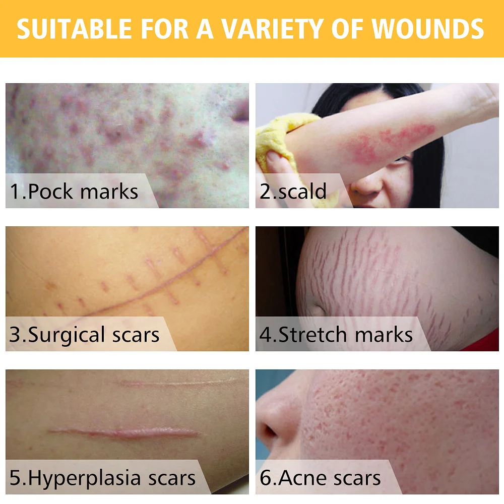 

Stretch Marks Remove Discounted Price Acne Scar Treatment Whitening Cream Pimple Scar Pregnancy Nourish Skin Care