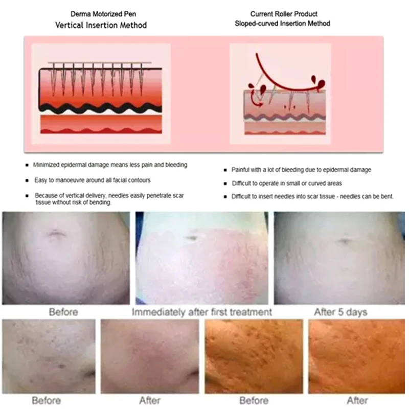 Игла с золотыми микроиглами штыковой картридж 12 иглами нано иглы MYM наконечник