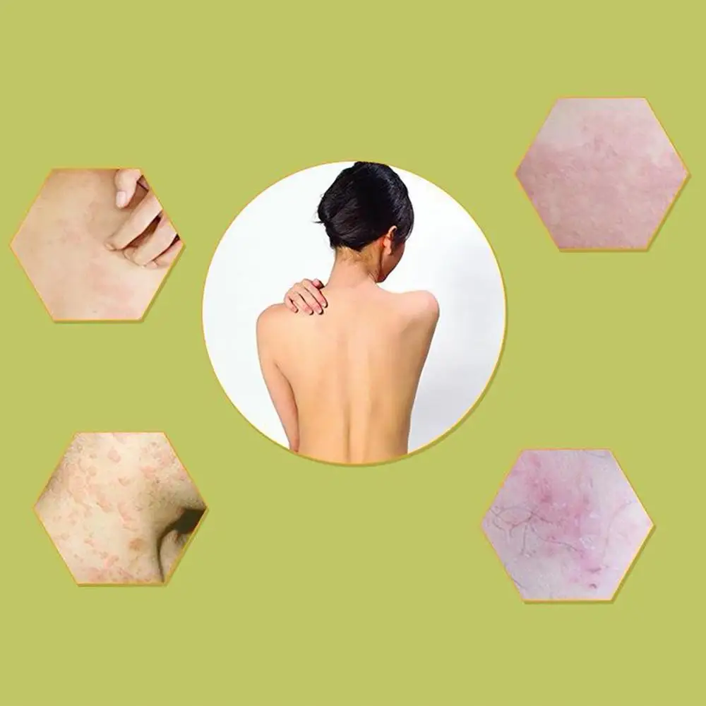 20 г крем для ухода за кожей экземы зуда вулказа псориаза системная tinea capitis