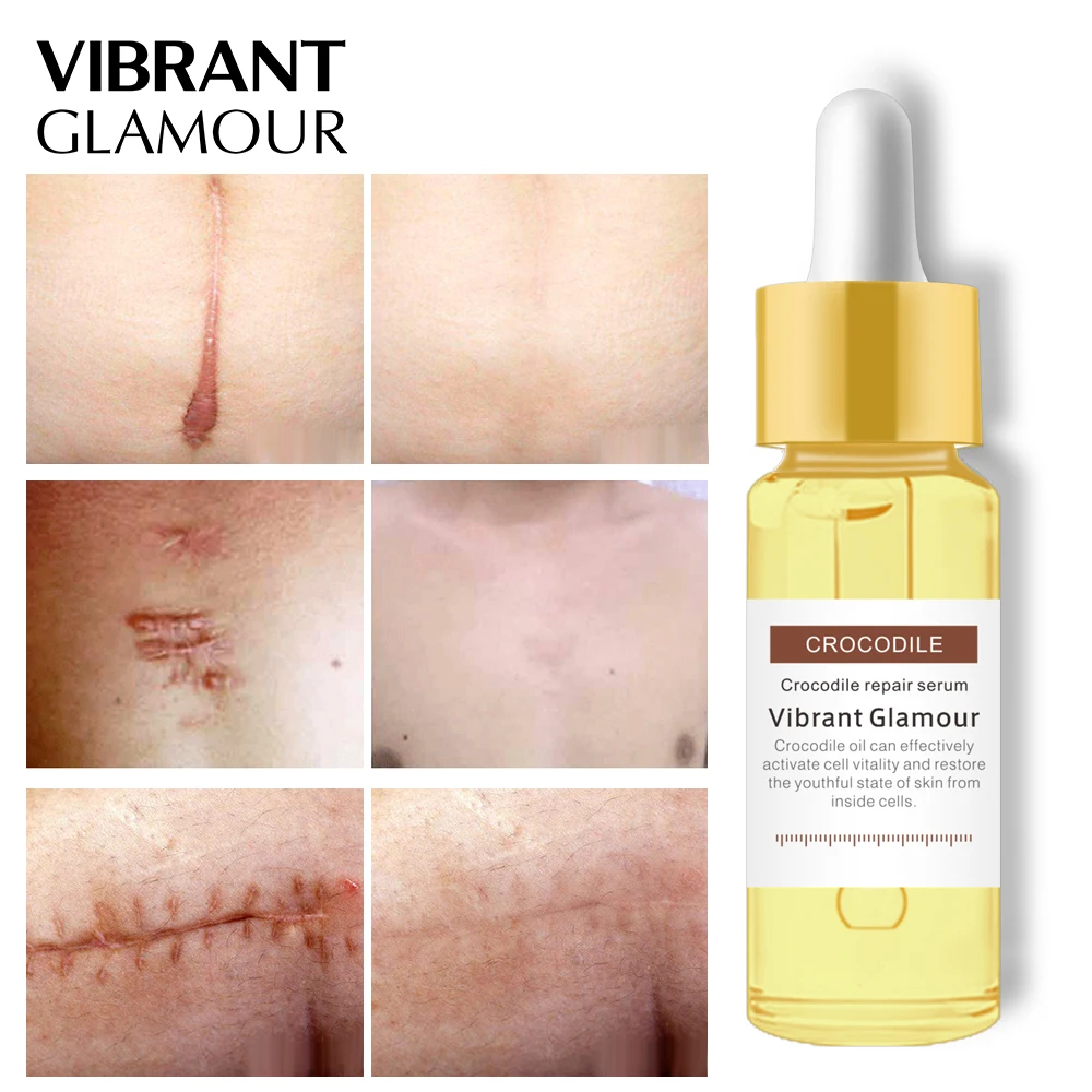 

Acne Scar Removal Face Serum Dispel Pimples Stretch Marks Remove Acne Treatment Smoothing Whitening Moisturizing Body Skin Care