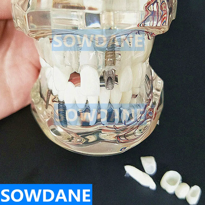 Модель зубного имплантата с мостиком для восстановления зубов стоматолог