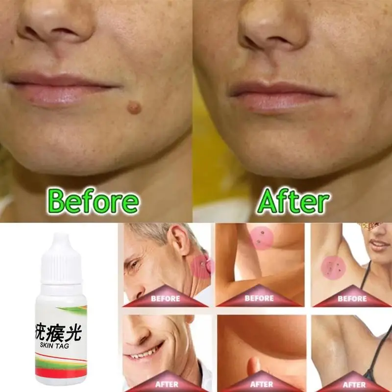 

10ml Skin Tag Remover 12 Hours Tu Kill Medical Tu Kill Corn Remov Mole Blackhead Wart Remover Remover Tag Genital Foot Skin W0W0