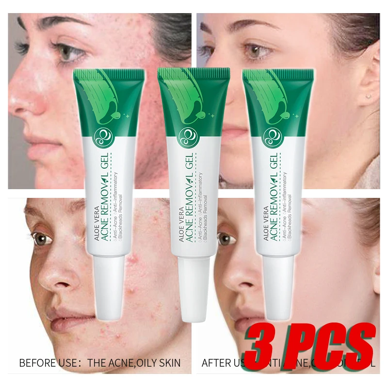 

Fast Shipping 3 PCS Aloe Vera Acne Treatment Gel Face Serum Remove Scar Moisturizing Anti-Acne Scar Oil Control Soothing Redness