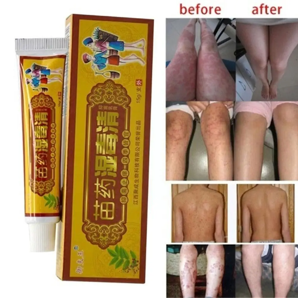 15 г/флакон натуральный травяной материал псориаз кремы мазь и патчи для кожи Eczema