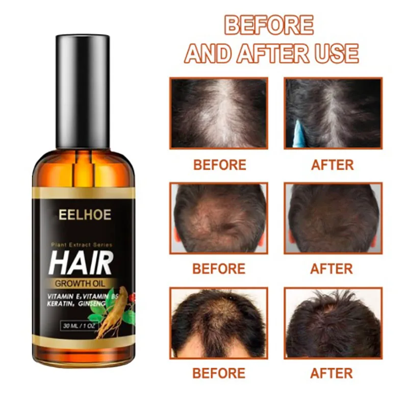 

Ginger Hair Loss Treatment Growth Essential Oil Tratamiento Para El Cabello Maltratado Soins Coupe Fourche Cheveux Repousse