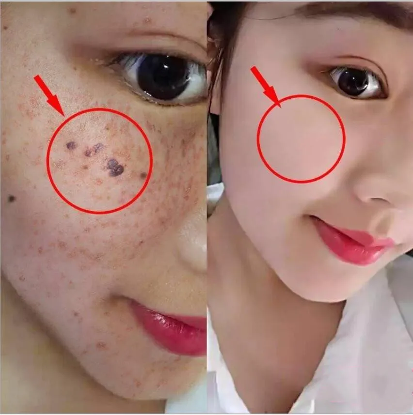 

20ML Face Mole & Skin Tag Repair Solution Painless Mole Skin Dark Spot Repair Face Wart Tag Freckle Repair Cream Essential Oil