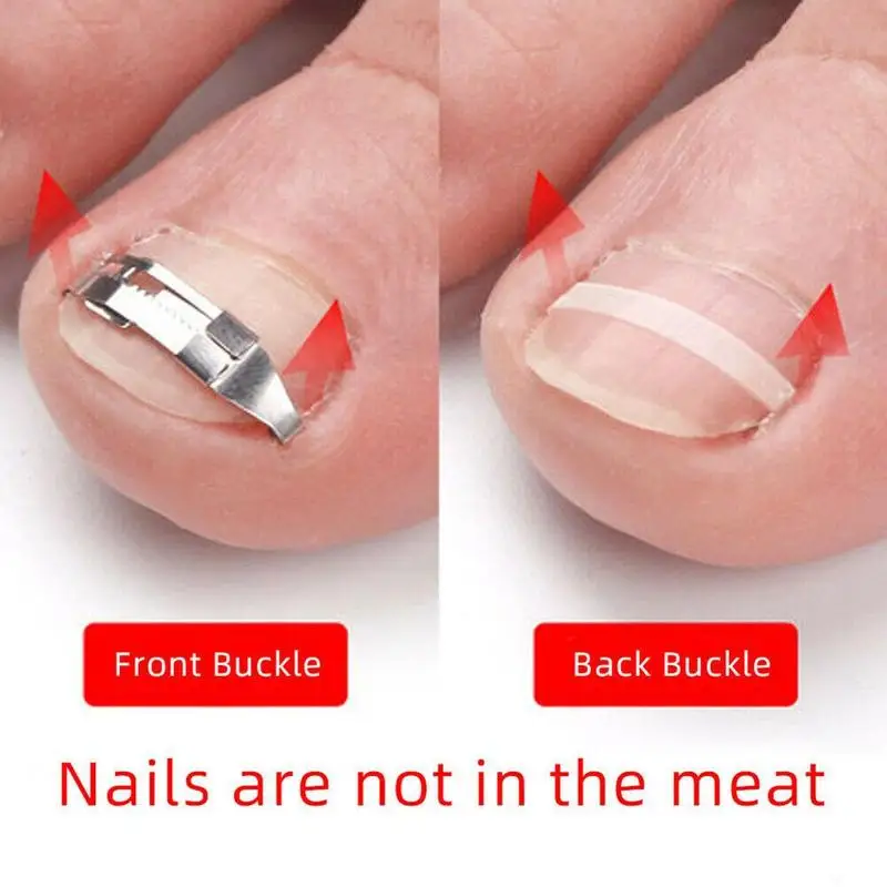 

1pair Ingrown Nail Correction Nail Fixer Embed Toenail Care Correction Pedicure Recover Tool Pedicure Foot Tool Lifter Tool A8X8