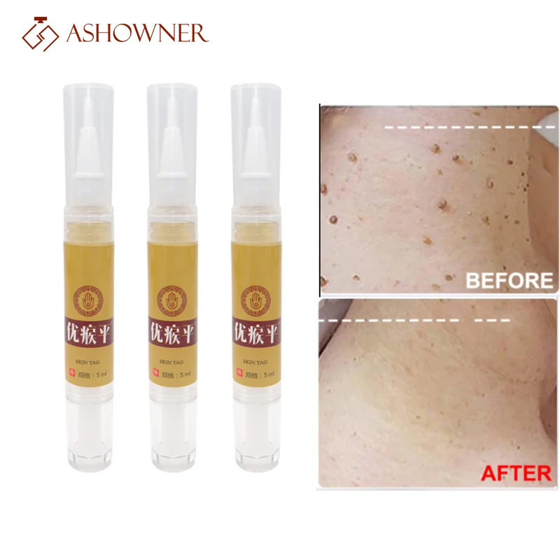 

Skin Tag Remover Against Mole Genital Wart Remove Within al Anti Foot Corn Removal Warts Papillomas Rapidly removes moles