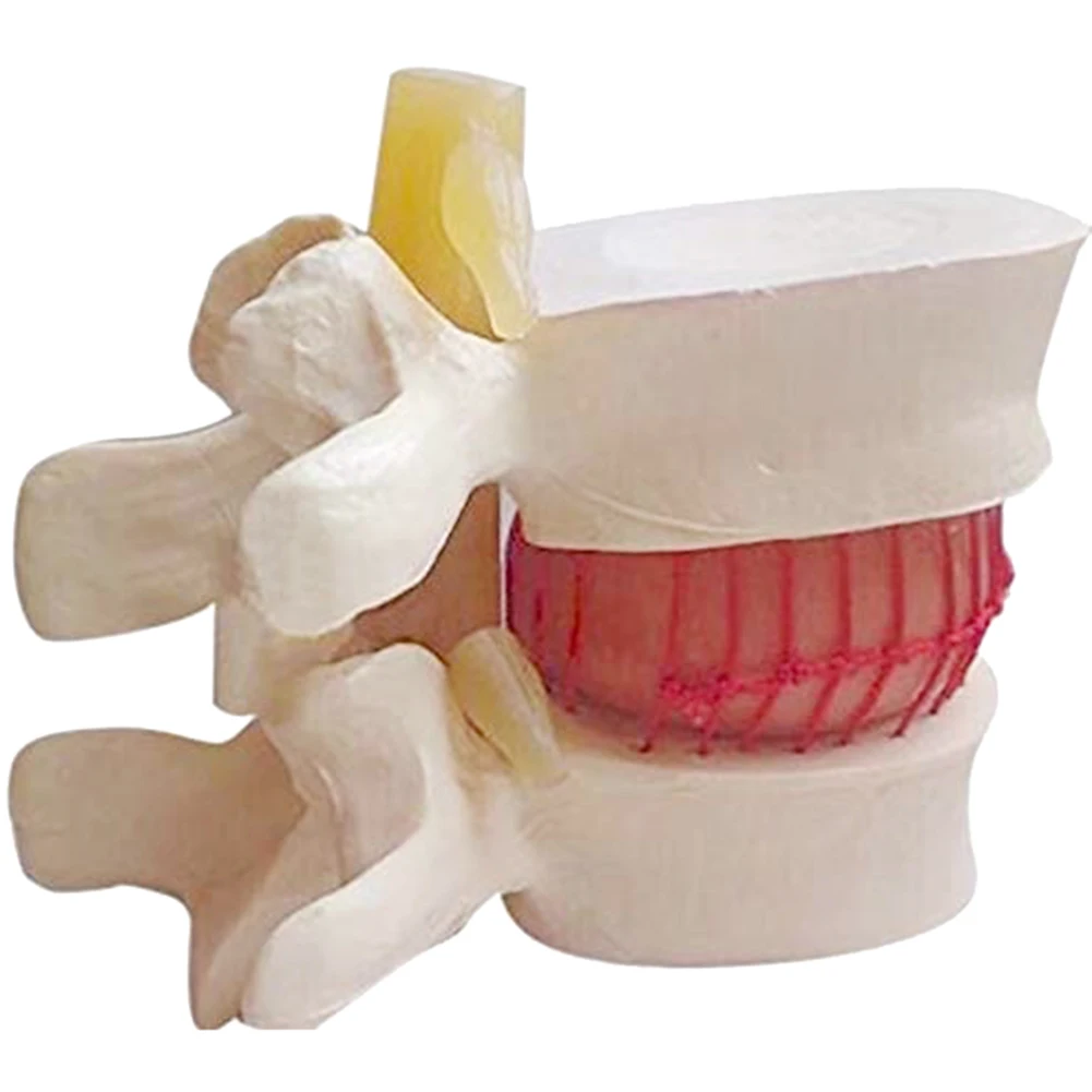 

1pc Anatomical Lumbar Disc Herniation Lumbar Spine Model White Color EM88