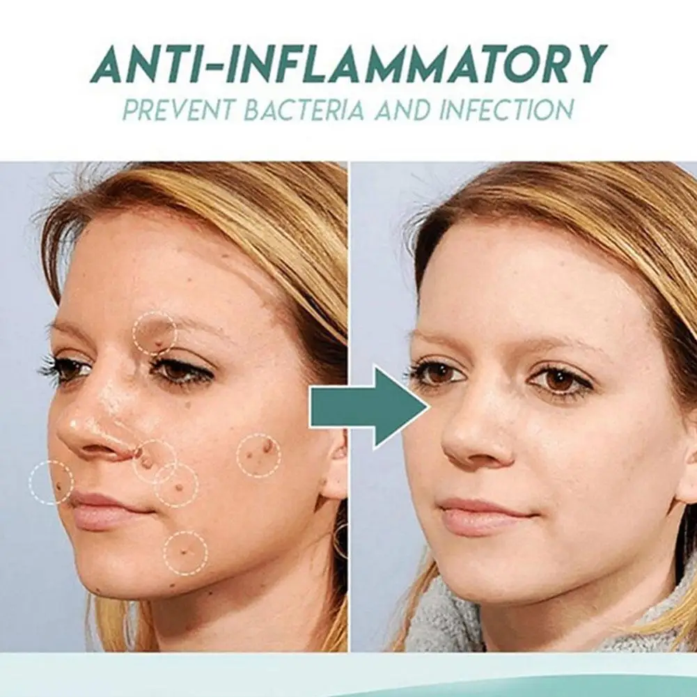 

3ml Genital Wart Against Moles Remover Treatment Papillomas Warts of Removing Cream Skin Removal Anti Liquid from Tags Verr P0J8