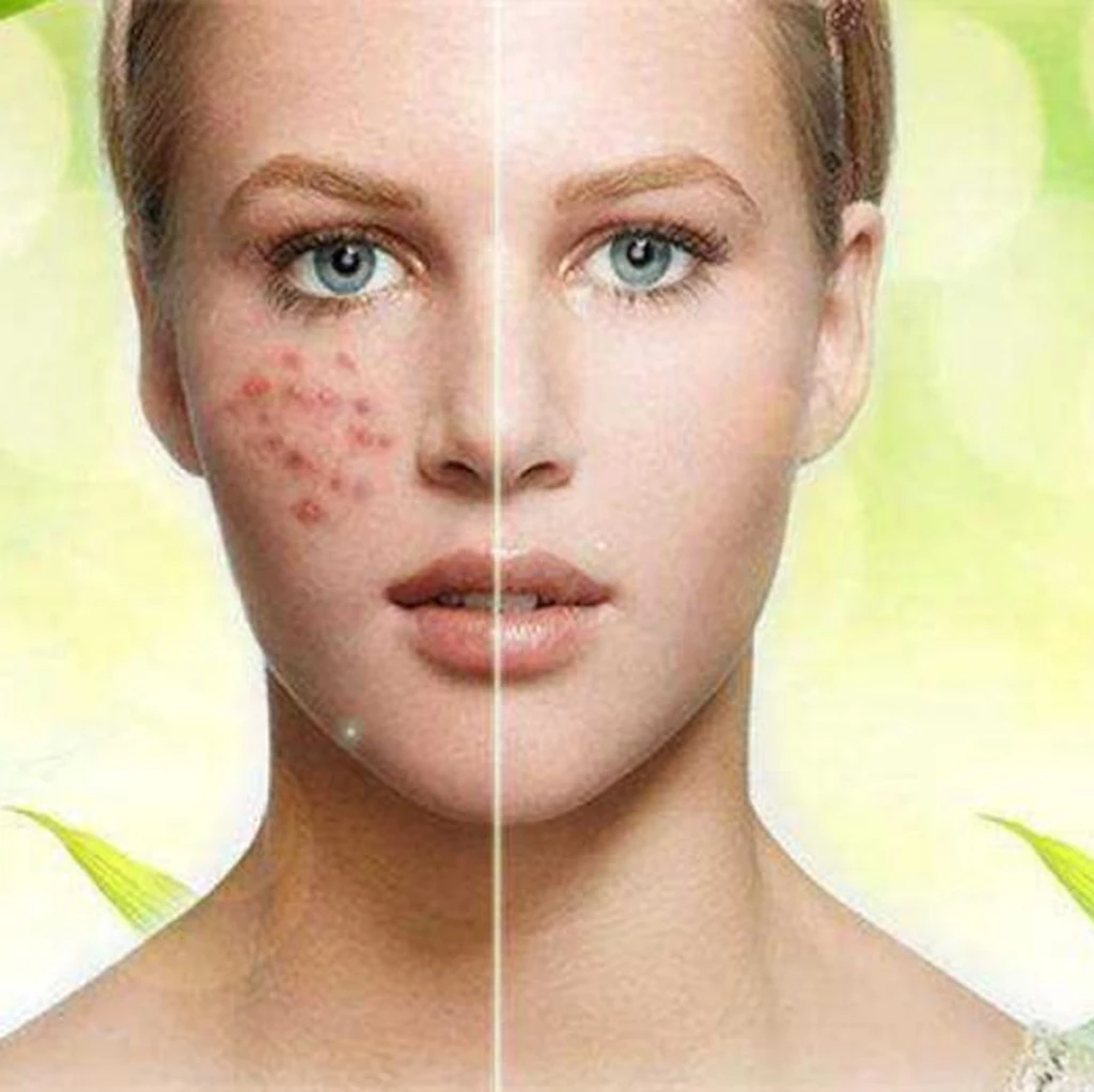 Мезотерапия для лица антиакне. Acne program