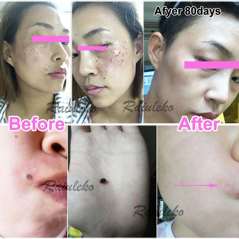 

6 stalls Micro Spot Freckle Mole Removal Plasma Pen Portable Skin Care Machine Laser Remove Spots Speckle Nevus Beauty Equipment