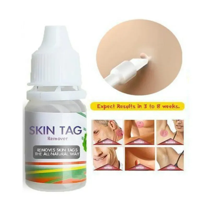 

Skin Tag Remover 12 Hours Tu Kill Medical Tu Kill Remover Skin Tag Mole Genital Wart Remover Foot Corn Blackhead Remover care