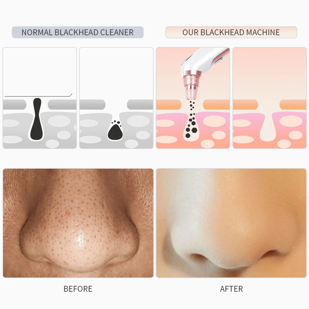 Устройство для удаления черных точек акне прыщей пылесос|Устройство ухода за