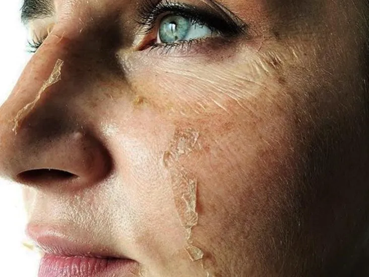 100% TCA кислота для очистки кожи (1 унция) Бирки возрастные пятна белые растяжки