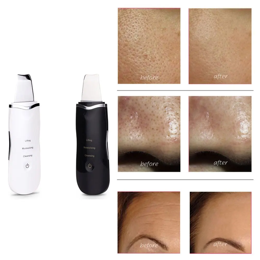 

Ultrasonic Blackhead Clean Shovel Skin Cleansing Instrument Beauty Instrument Face Skin Whitening Lifting Effect Device