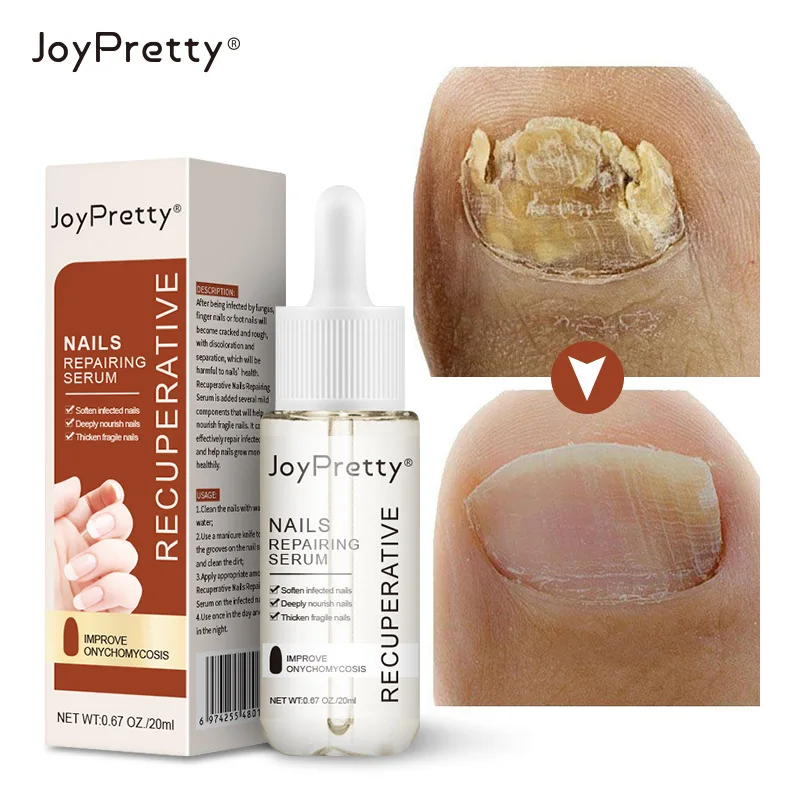 JoyPretty Foot Nail Fungus Treatment Serum Anti Fungi Feet Care Whitening Toe Nail Polish Oil Antifungal Foot Repair Essence 20g