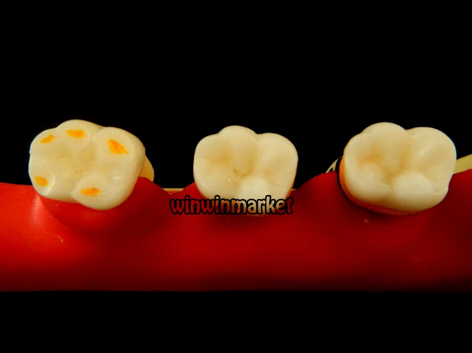 5-ступенчатая Стоматологическая одонтология периодонтальное заболевание