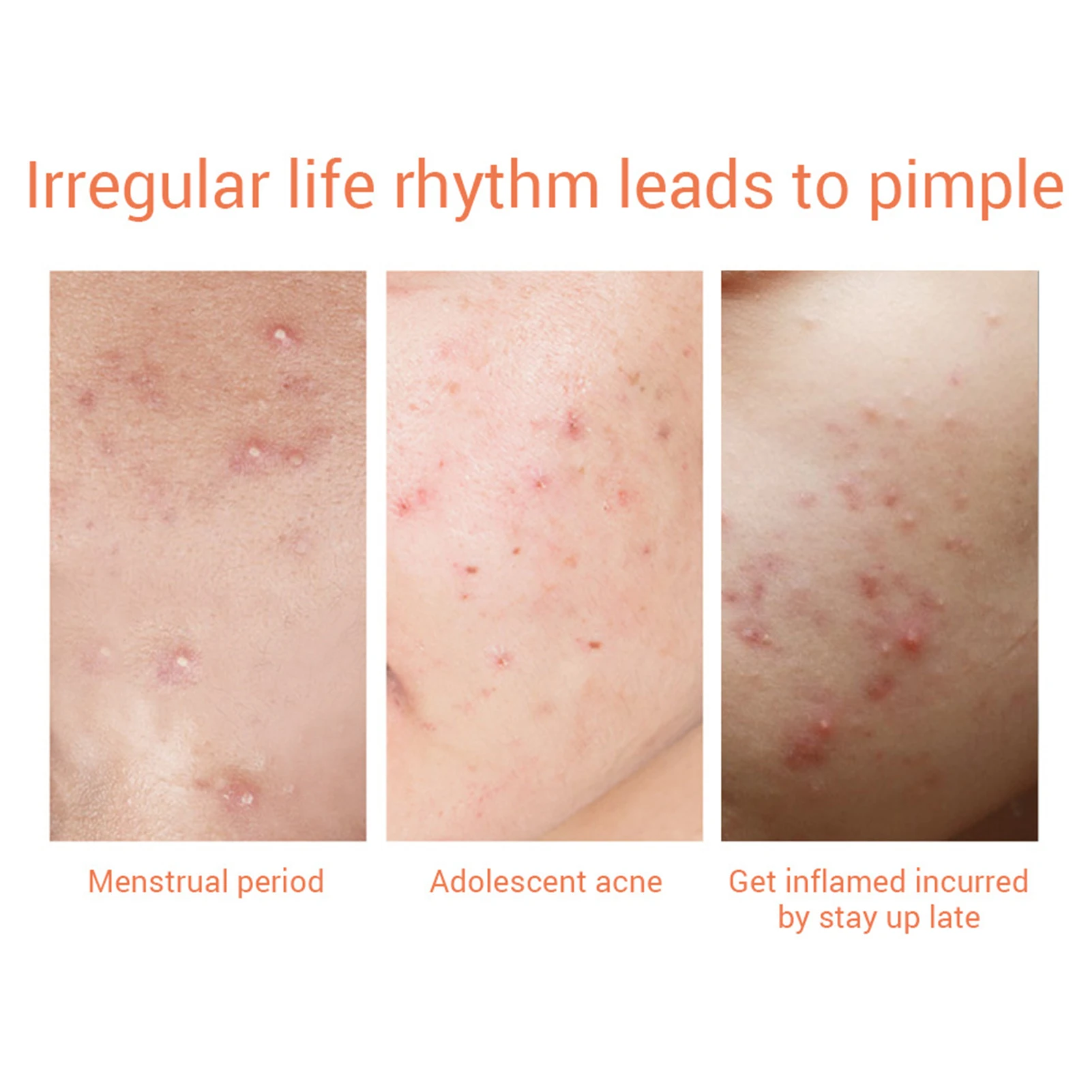LANBENA Waterproof Day Use Acne Sticker Pimple Remover Patch Skin Care Treatment