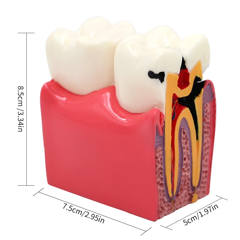 

6 Times Caries Dental Comparsion Model For Dental Study Teaching and Researching as Anatomy Education Teeth Model