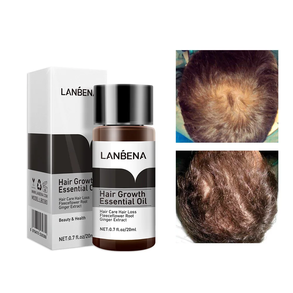 

LANBENA Fast Powerful Hair Growth Essence Products Essential Oil Treatment Preventing Hair Loss Hair Care Andrea 20ml
