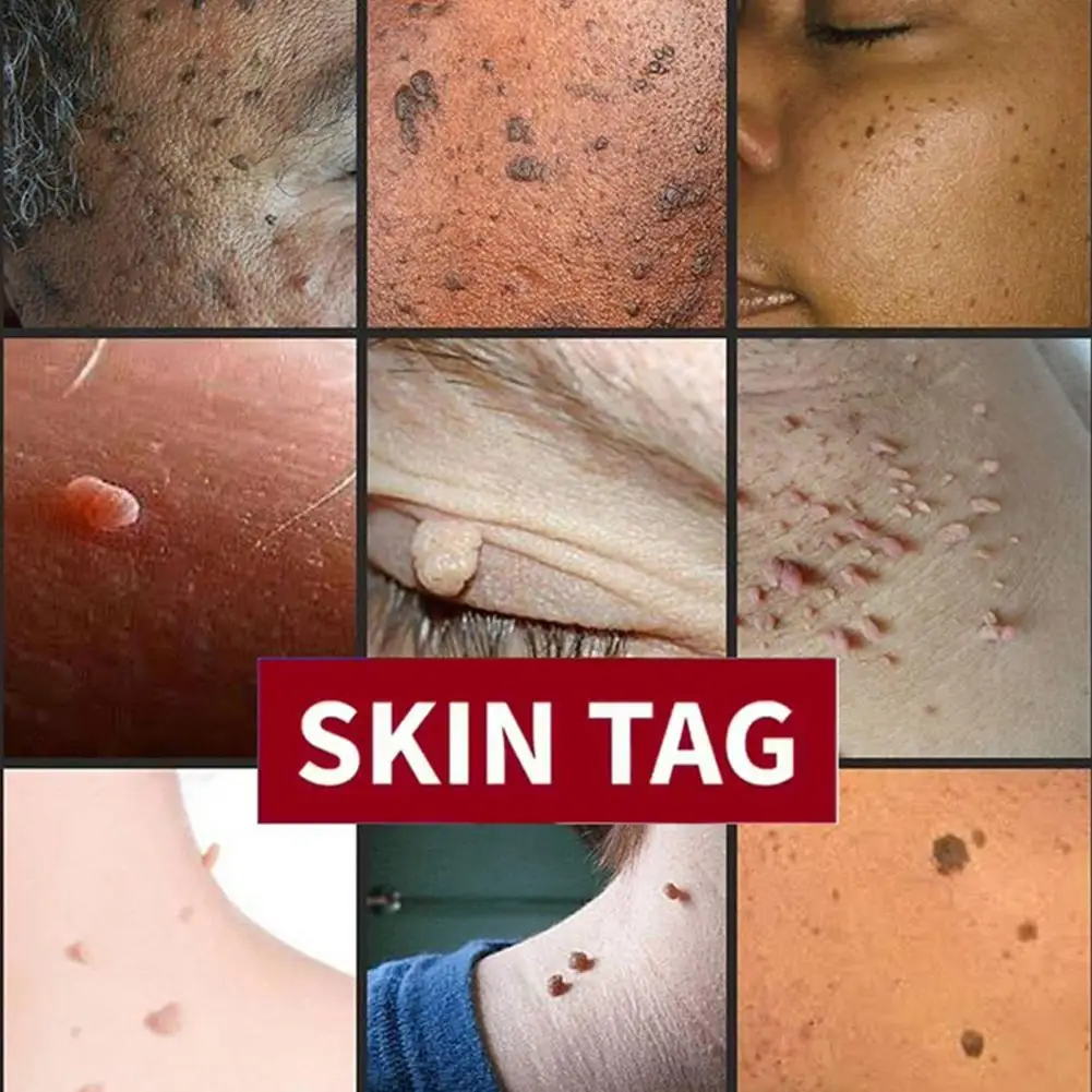 3 мл этикетка для кожи искусственная кожа травяной экстракт сыворотка родинка