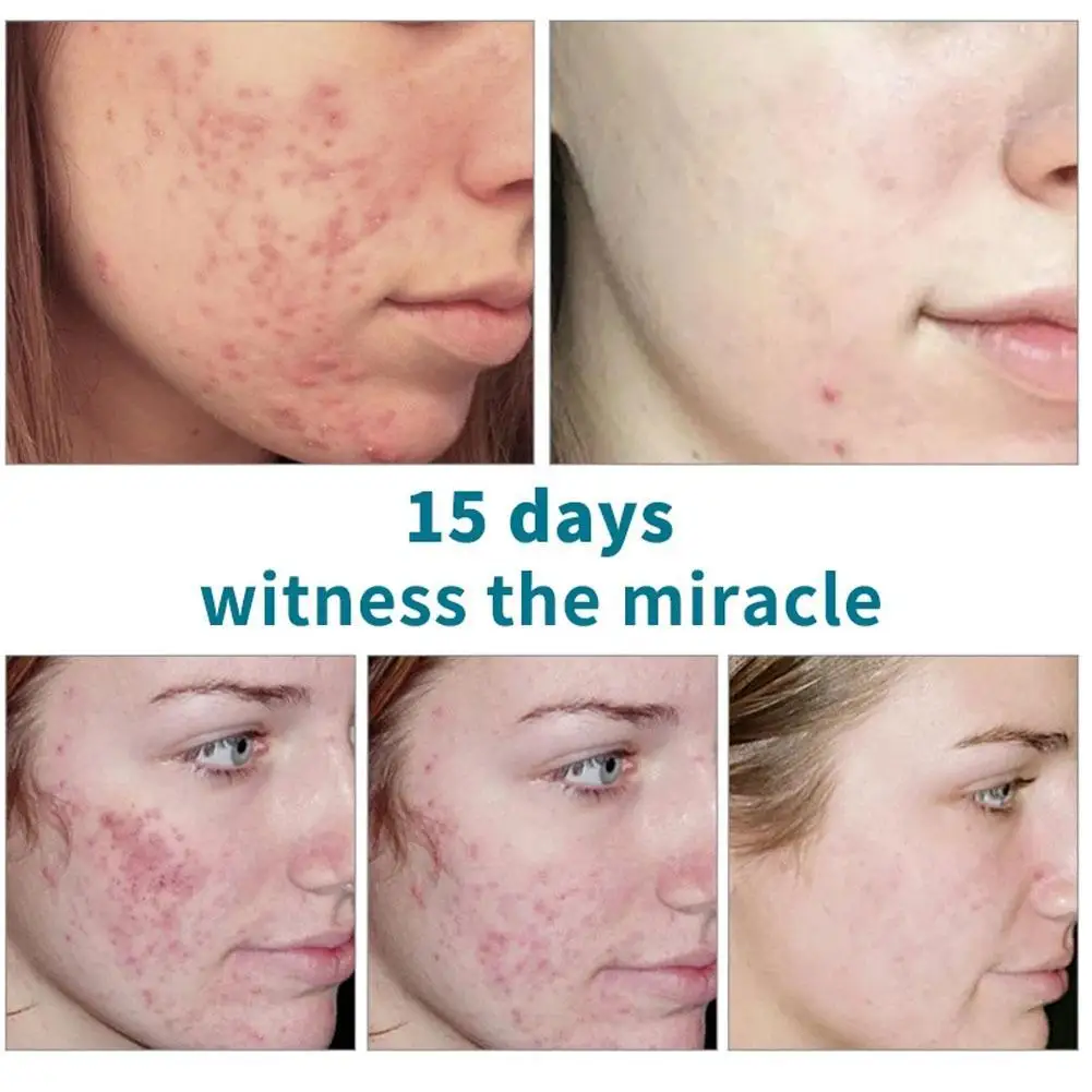 

Aloe Anti-acne Cream Effective Moisturizing Whitening Face Cream Remove Acne Treatment Pigmentation Dark Spots Cream Skin Care