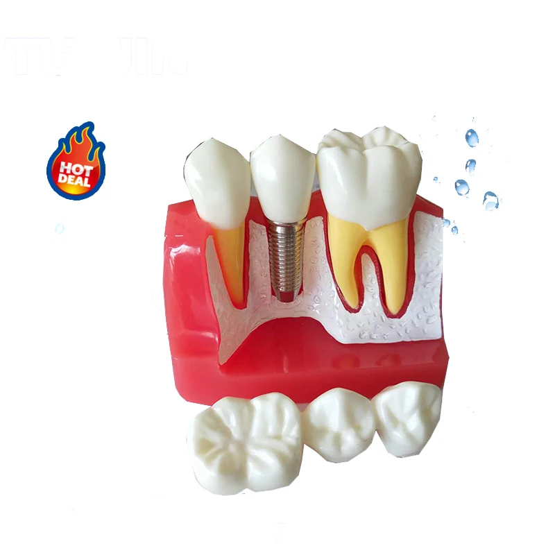 Зубной имплантант модель зубов Стоматологическая лаборатория Стоматология для