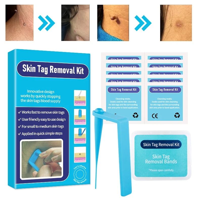 Skin Tag Removal Kit Mole Wart Remover Equipment Micro Skin Tag Treatment Tool Home UsecEasy To Clea