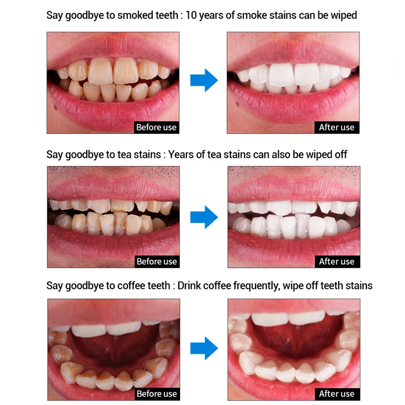 Гель-сыворотка для отбеливания зубов 10 мл | Красота и здоровье