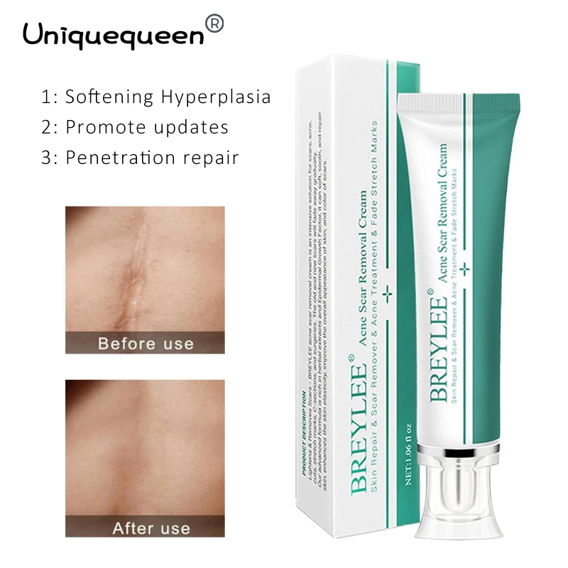 

Крем для удаления шрамов, прыщей, растяжек, осветления шрамов, лечение от прыщей, отбеливание питательный глубокий уход за кожей, 30 г