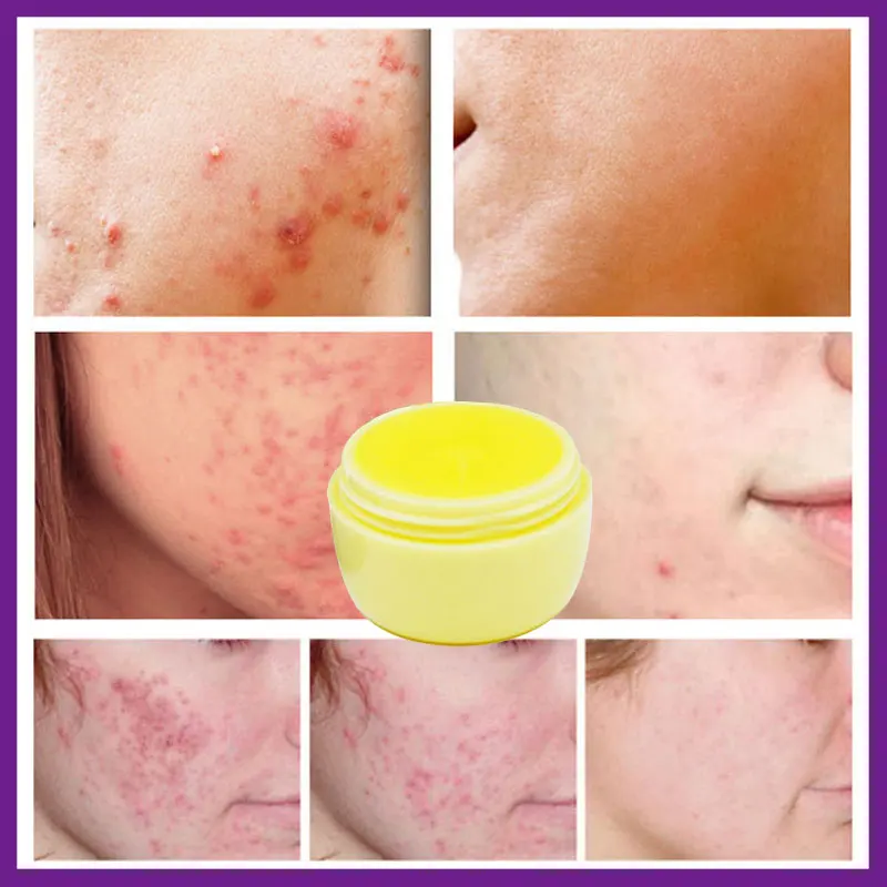 Original Vietnam Curcuma Oil Acne Ointment Ginger Remove Scar Cream Pores Treatment Face Vitamin B2 Natural Herbal |
