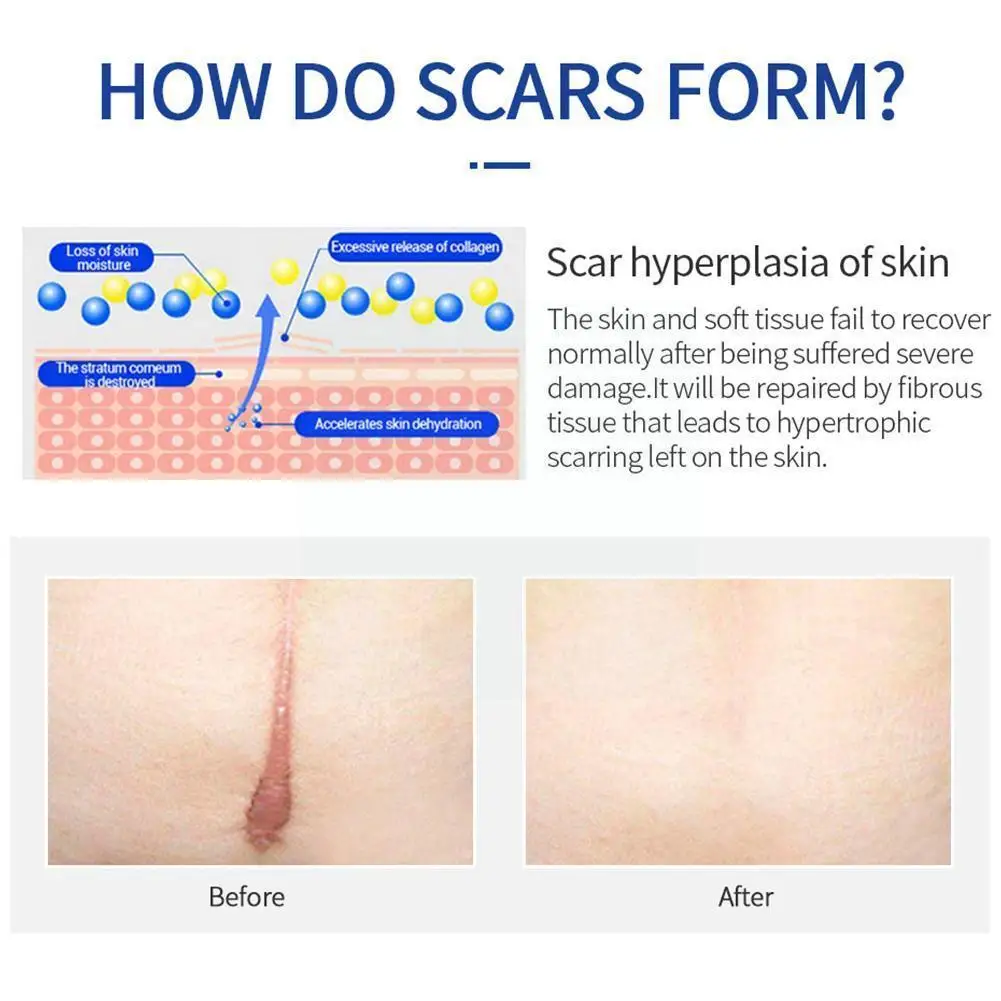 

20g Scar Gel Cream Repair Stretch Marks Scar Cream Skin Whitening Fading Scar Care Treatment Scar Scar Acne Burn Smoothing W4q5