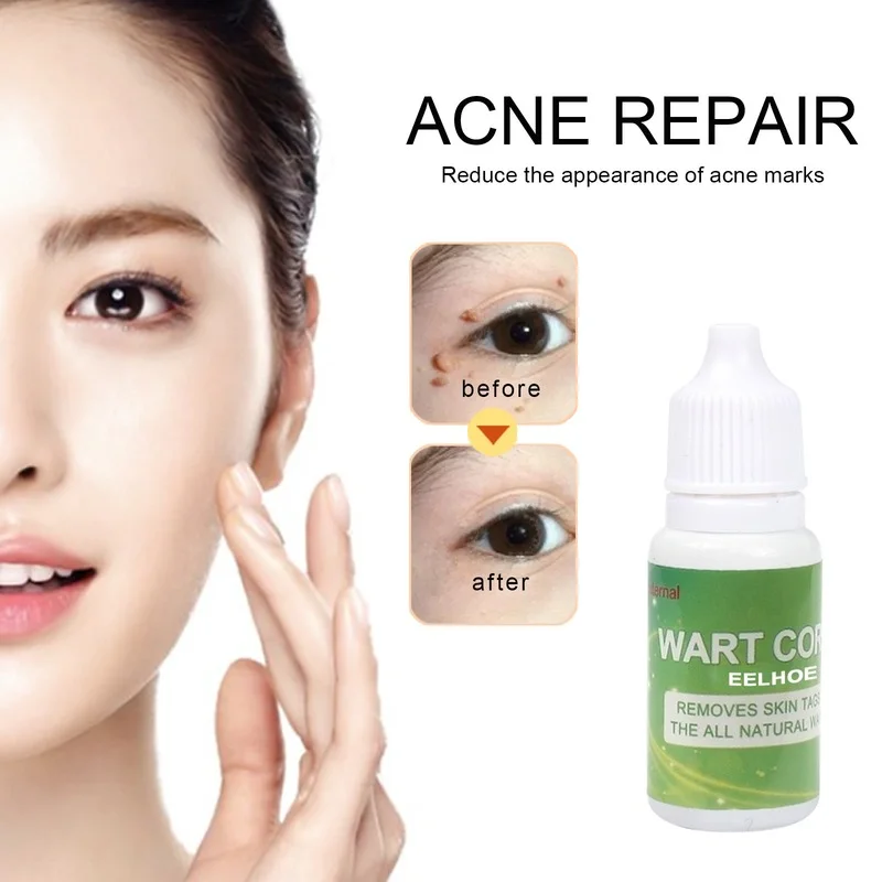 

Mole Elimination Potion Skin Dark Spots Remover Lighten Melanin Face Essential Oil Serum Facial Acne Repair Skin Care