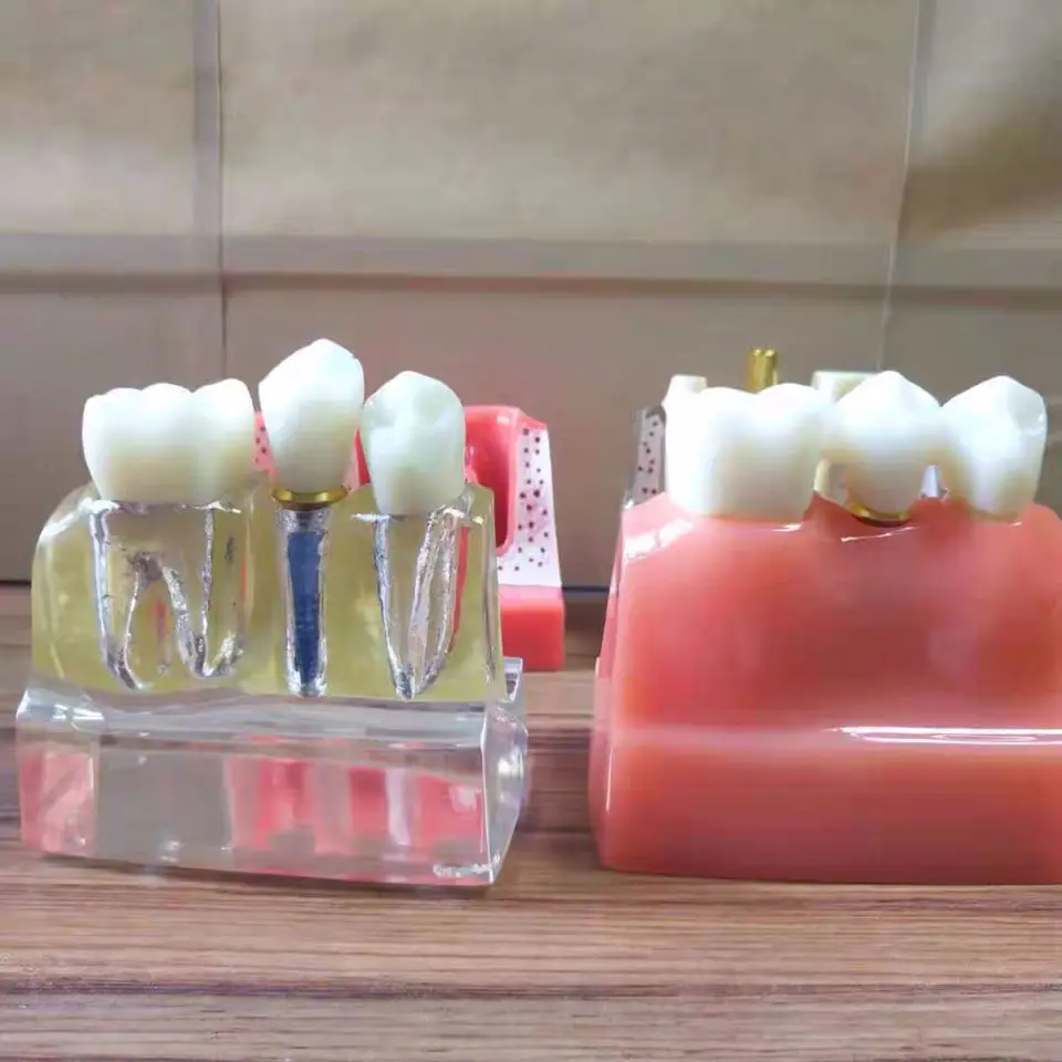 1 шт. 4 кратная модель имплантатов зубов орального обучения стоматологической