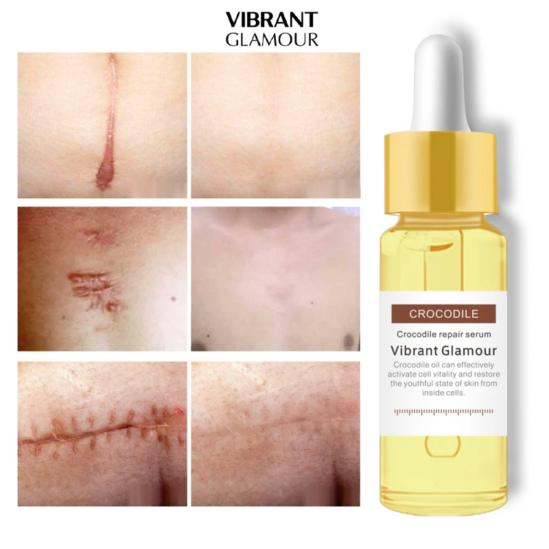 Интенсивный лечебный экстракт для восстановления шрамов крокодила лечение акне