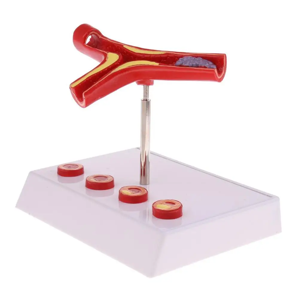 Лабораторные принадлежности 50 раз увеличенный человеческий сосуд атеросклероза