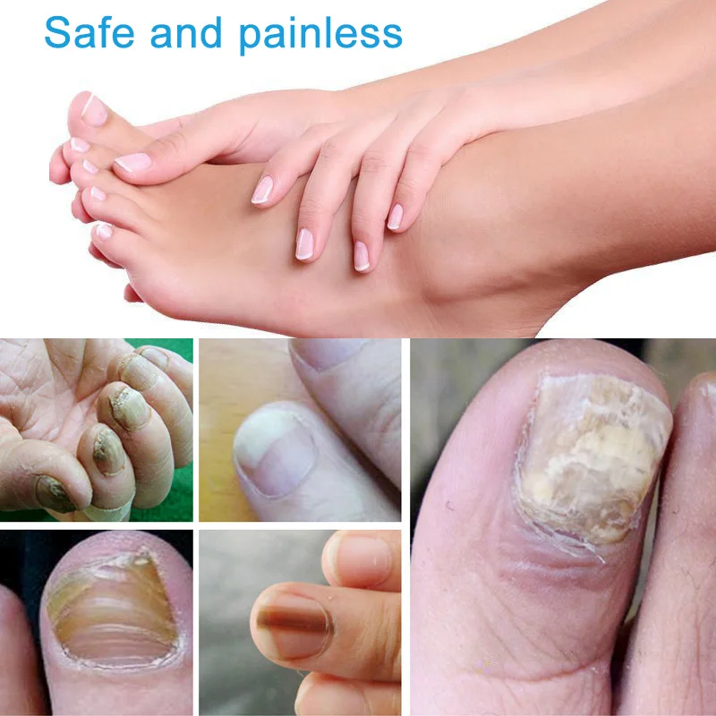 

Nail Repair Care Liquid for Toenail and Fingernail Hydrates Repair Yellow Cracked Nails SOYW889