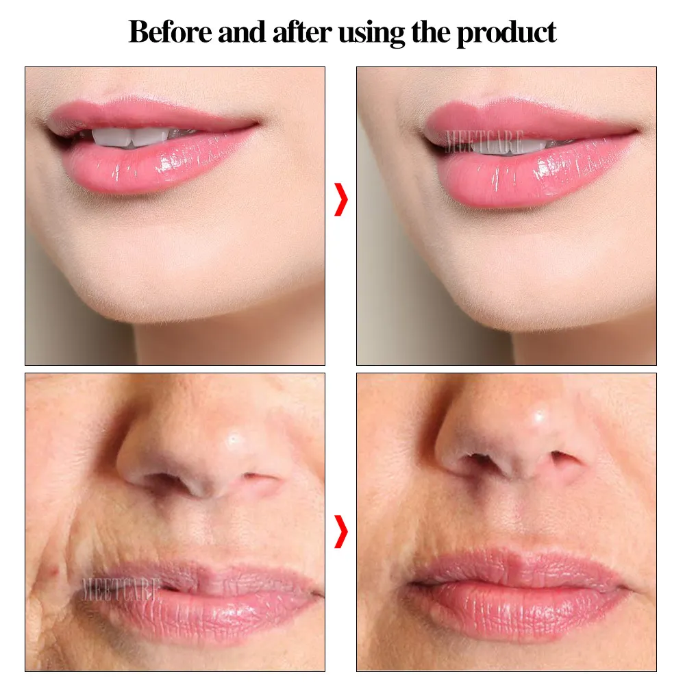 Трехзубчатая ручка с гиалуроновой кислотой высокой плотности для потери веса