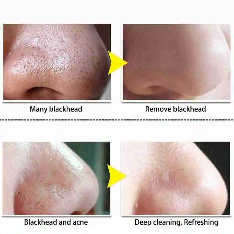 

5pcs/Pack Nose Blackhead Remover Mask Shrink Pore Acne Deep Cleansing Care Mask Pore Skin Treatment Clean Strips N5C8