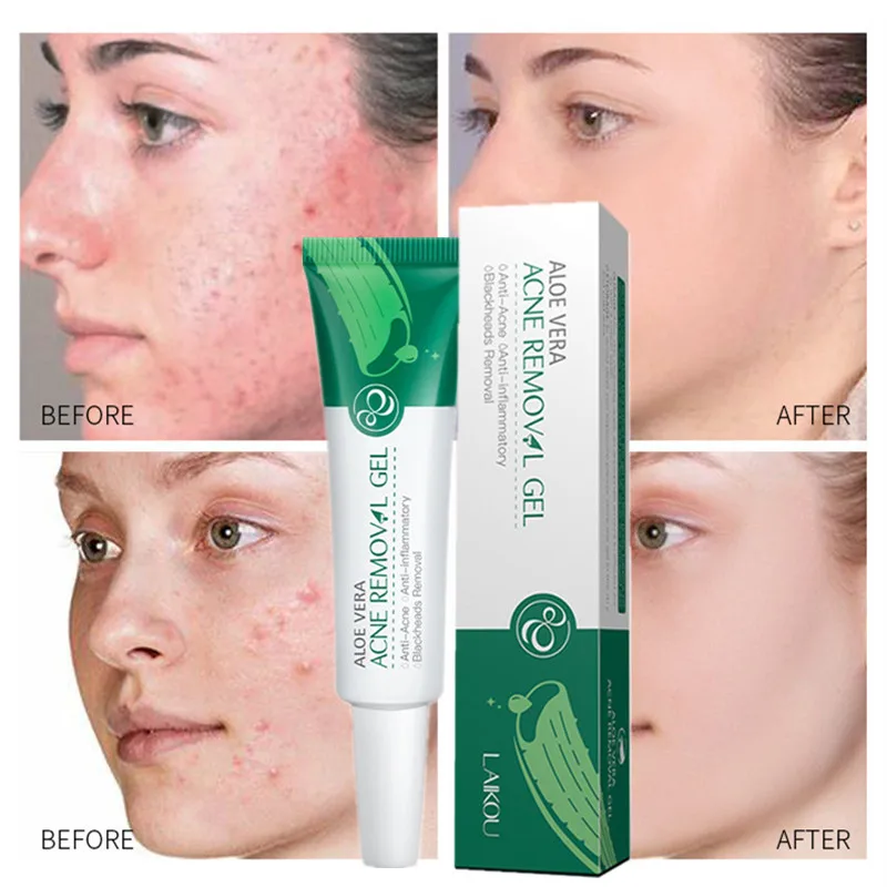 

Aloe Acne Treatment Gel Face Serum Hyaluronic Acid Moisturizing Anti-Acne Scar Oil Control Soothing Skin Essence Care Cream