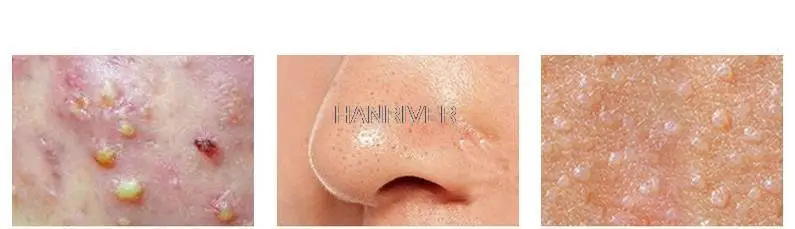 Набор инструментов для чистки пор лица | Красота и здоровье