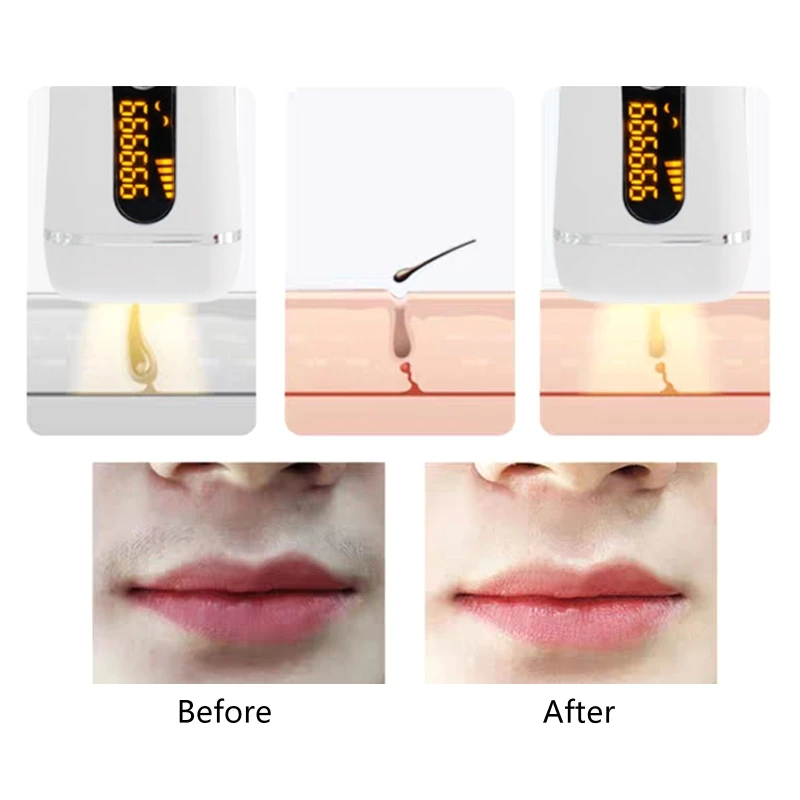 

painless hair removal device, suitable for full body bikini line, legs