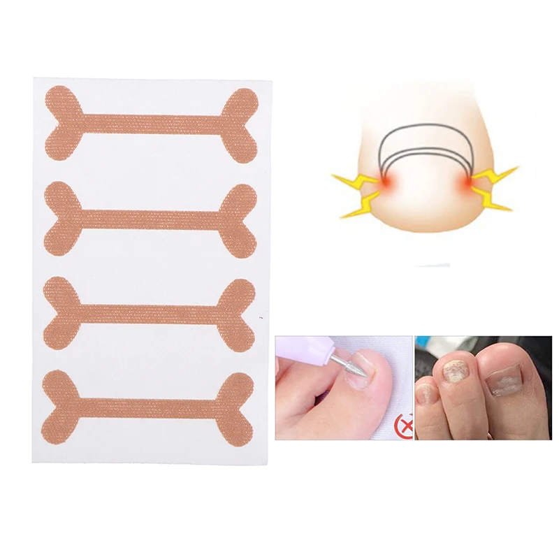 20Patches Ingrown Toenail Band Aid Relief Pain Paronychia Correction Pedicure Elastic Force Sticker Repair Bandage Toe Nail Care images - 6