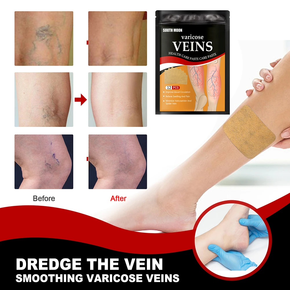 

12pcs Varicose Veins Patch Phlebitis Vasculitis Treat Sticker Thigh Spider Removal Pain Relief Plaster Remove Vascular Blockage