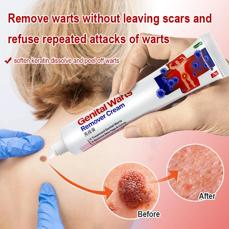 1pcs Wart Remover Cream Skin Tags Mole &amp Papillomas Treatment Private Parts Genital Antibacterial Ointment G006 | Красота и