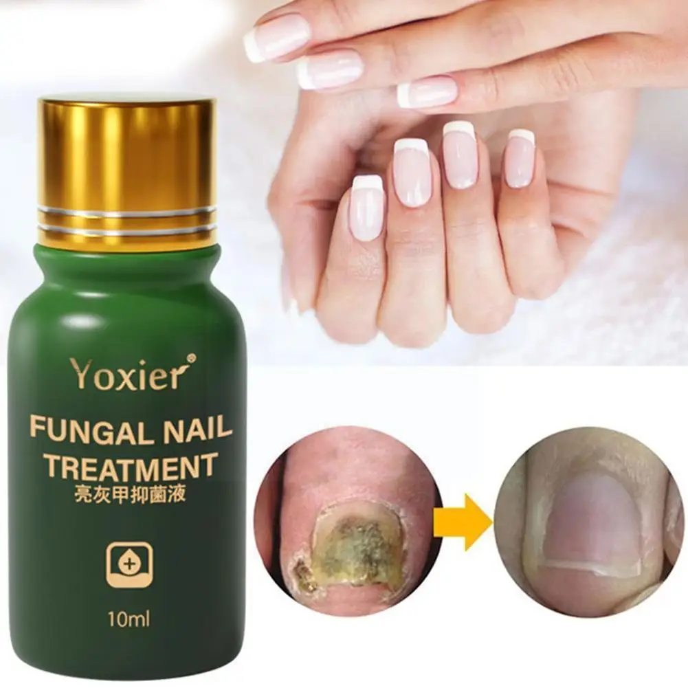 

Fast Nail Fungal Treatments Nail Repair Essences Serum Fungus Care Paronychia Removal Treatments Foot Onychomycosis Gel N1 V1S3