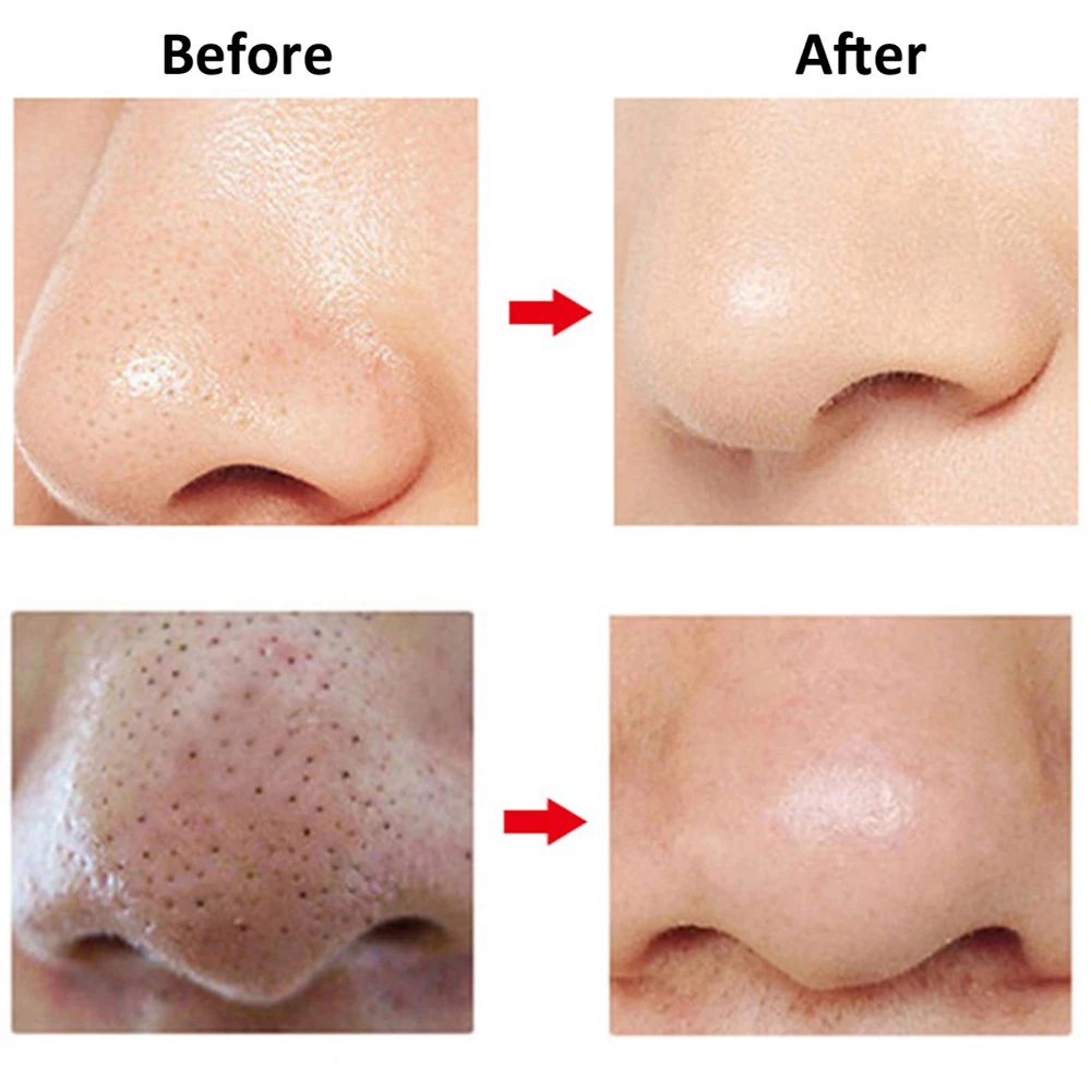 

Electric Blackhead Remover Vacuum Small Bubble Face Pore Cleaner Acne Grease Dirt Removal Skin Rejuvenation Beauty Instrument