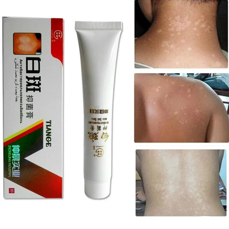 

White Spot Disease Cream Pigment Melanin Promoting Liniment Skin Vitiligo Leukoplakia Treatment plaster Massage Chinese Medicine